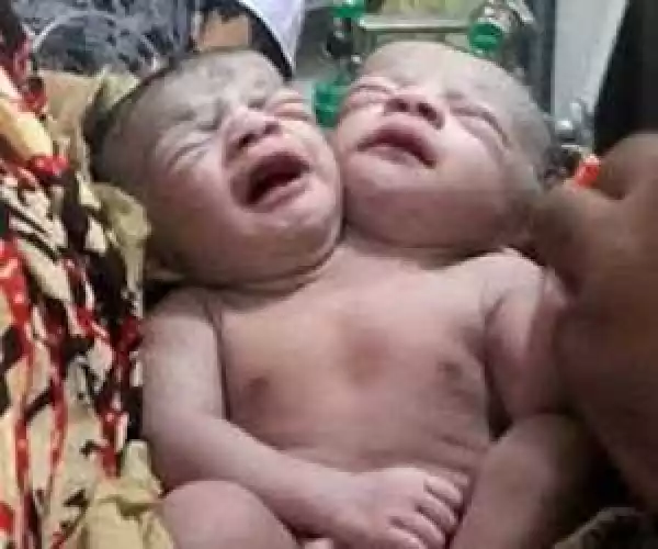 Baby with Two Heads Born in India as Crowds Queue for Glimpse of 